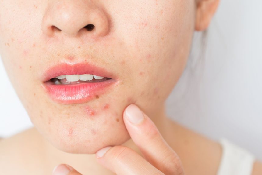 Acne, Pimples News, Research &amp; Treatment Studies | Blackheads Articles